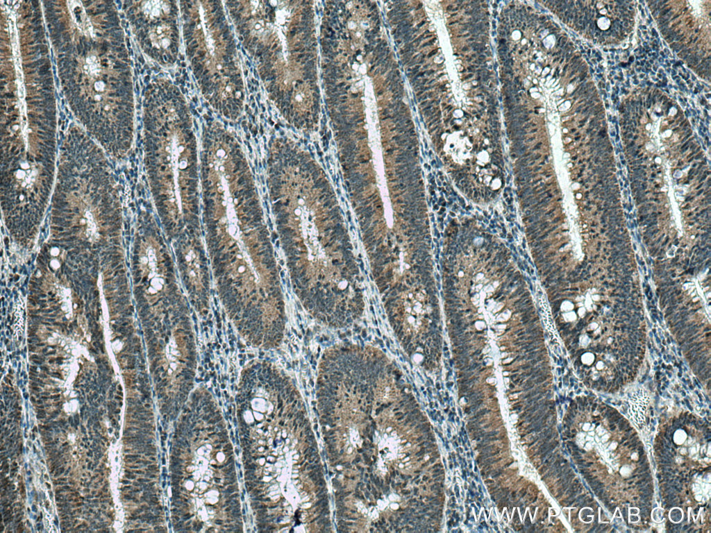 IHC staining of human colon cancer using 13306-1-AP