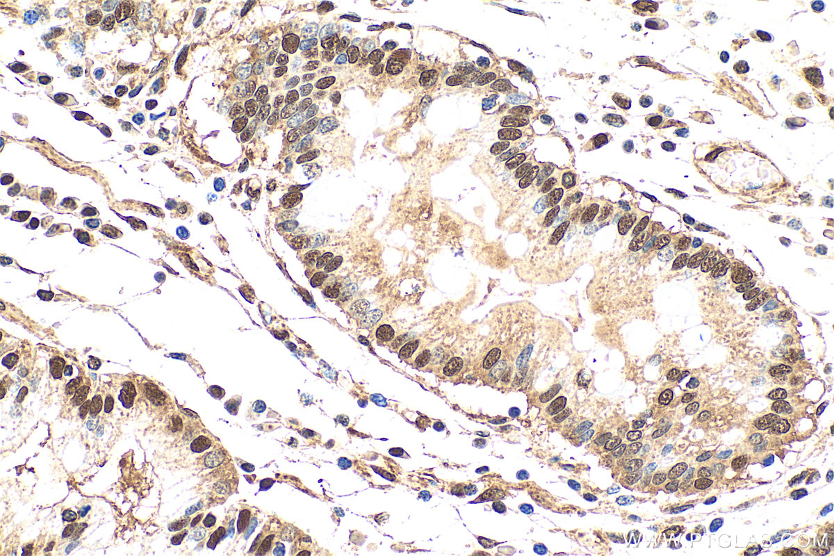 IHC staining of human stomach cancer using 27905-1-AP (same clone as 27905-1-PBS)