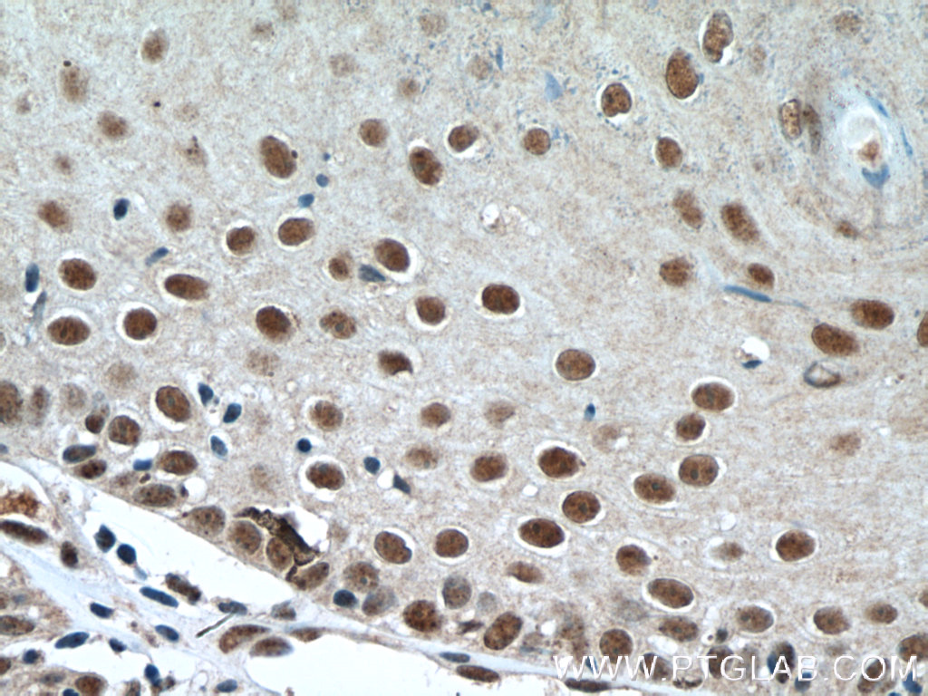 IHC staining of human skin cancer using 13639-1-AP