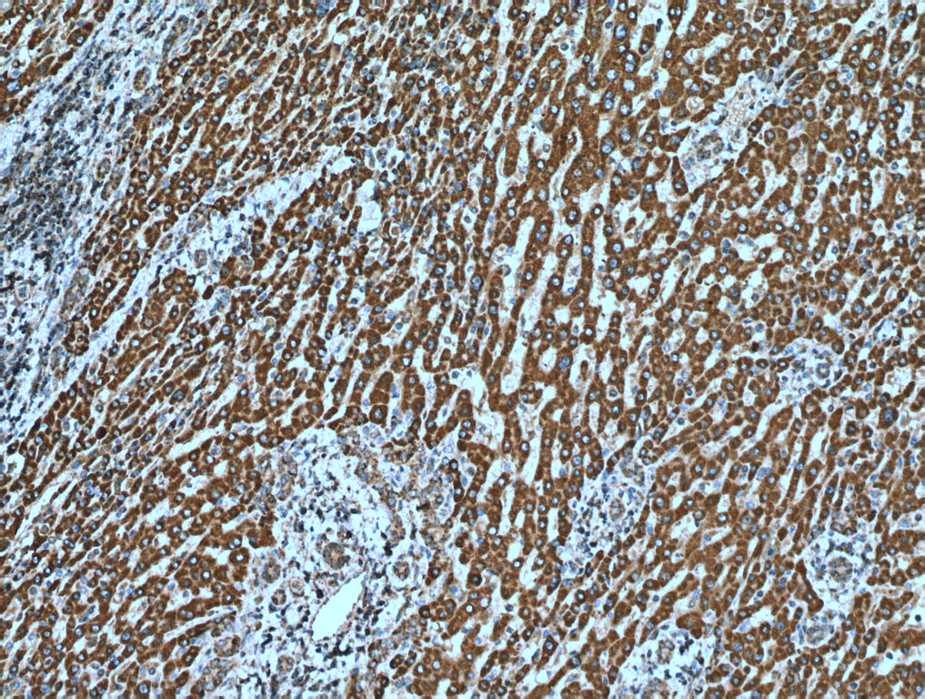 IHC staining of human liver cancer using 20697-1-AP