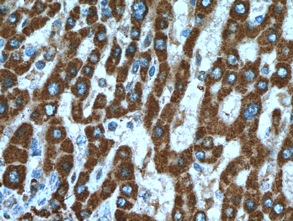 IHC staining of human liver cancer using 20697-1-AP