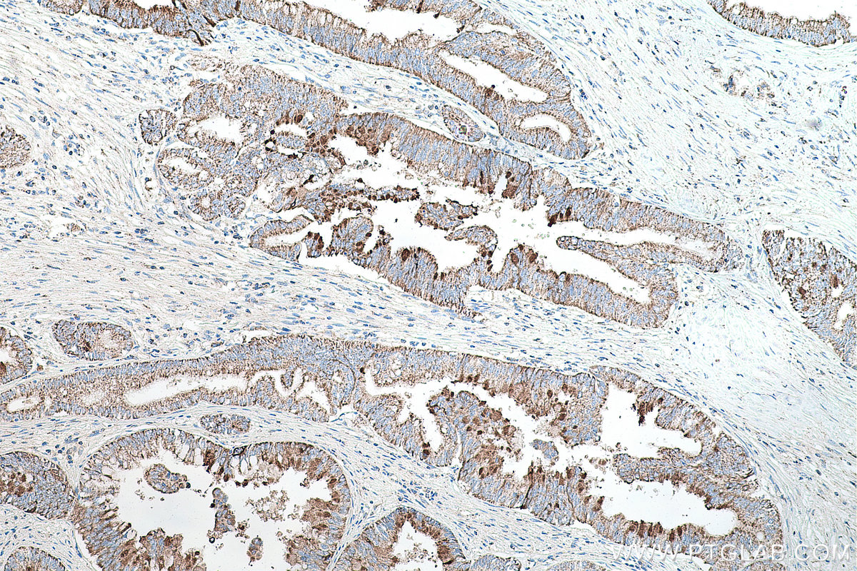 IHC staining of human pancreas cancer using 20697-1-AP