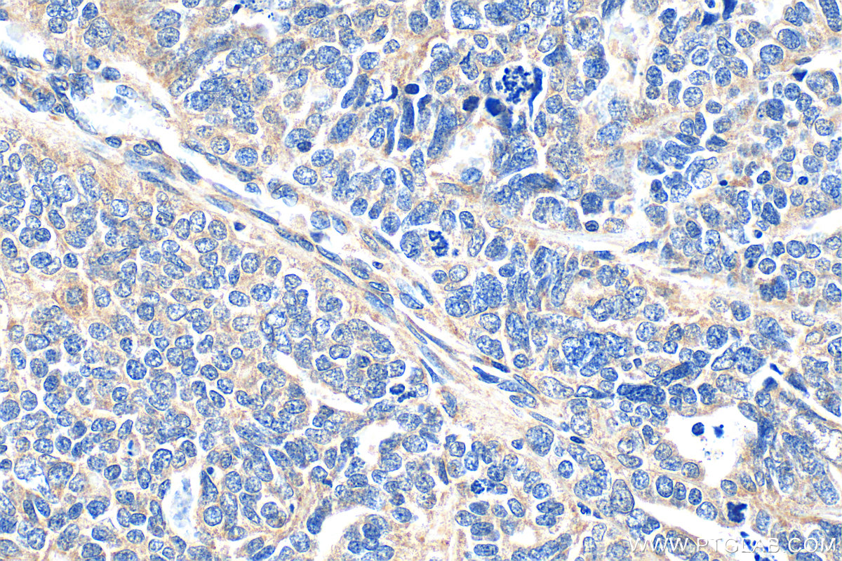 IHC staining of human ovary tumor using 24347-1-AP IHC staining of human ovary tumor using 24347-1-AP