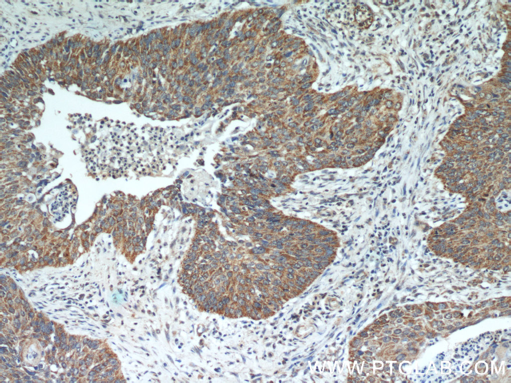 IHC staining of human cervical cancer using 11099-1-AP