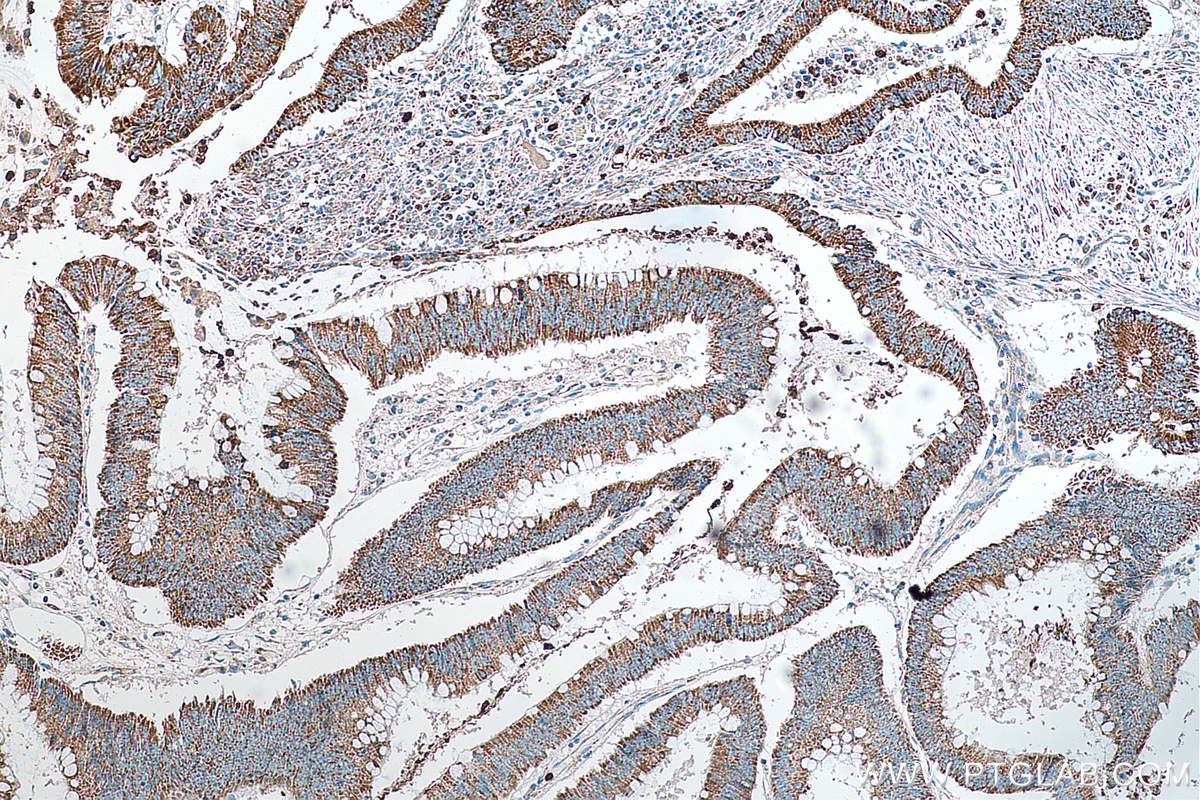 IHC staining of human colon cancer using 67980-1-Ig (same clone as 67980-1-PBS)