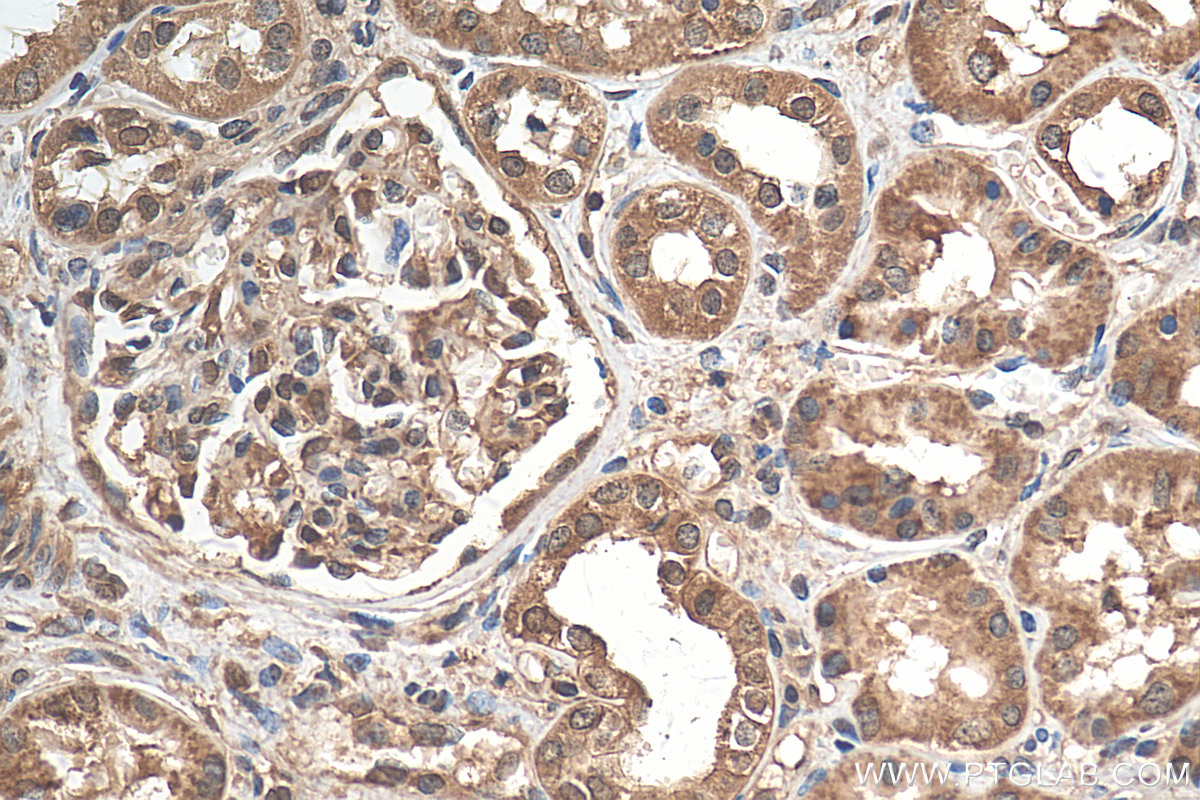 IHC staining of human renal cell carcinoma using 17561-1-AP