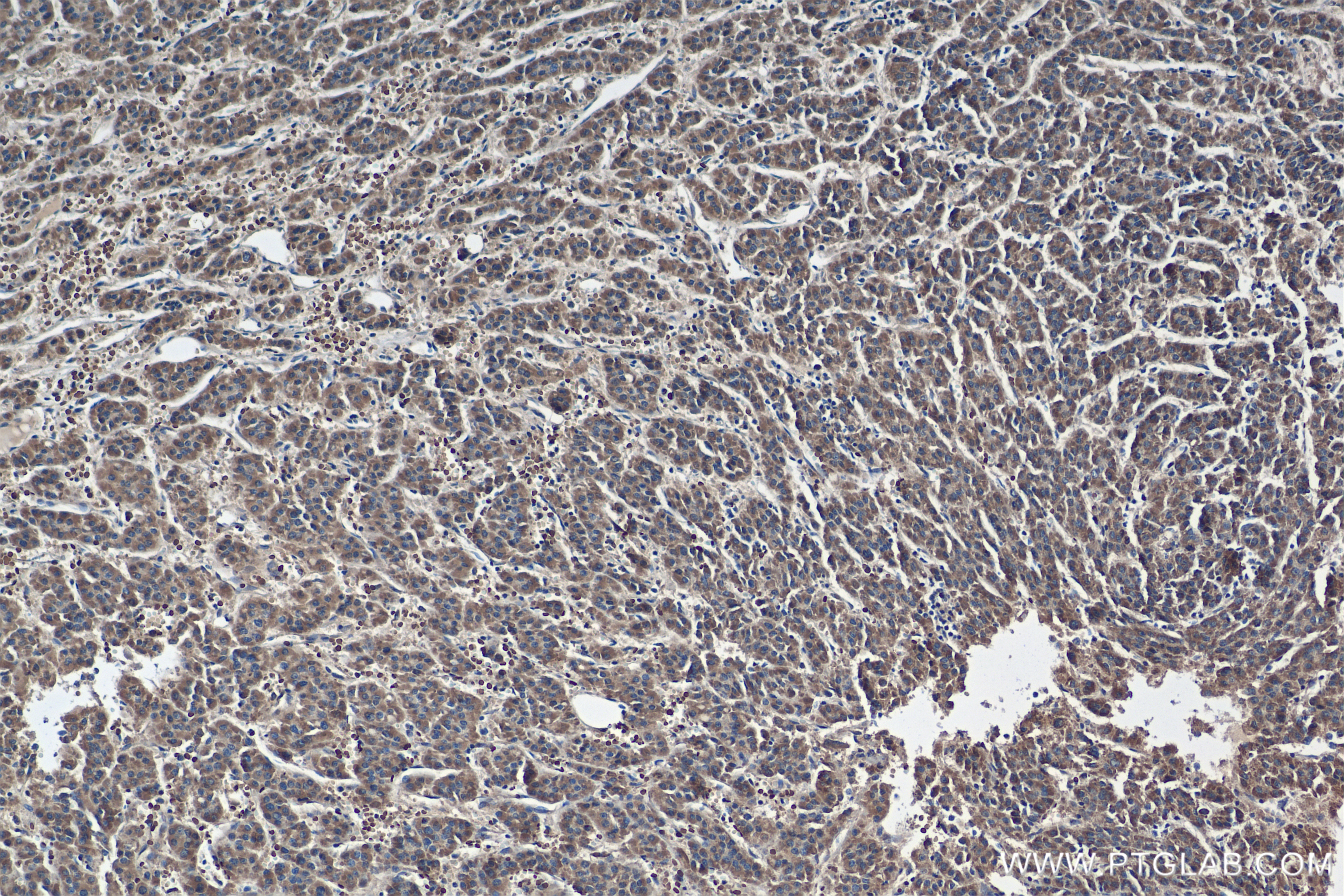 IHC staining of Human Hepatocellular cancer using 82875-1-RR