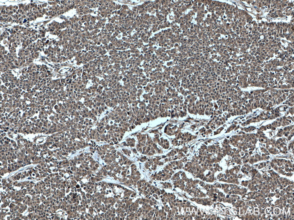 Immunohistochemical analysis of paraffin-embedded human colon cancer tissue slide using 27020-1-AP (SHQ1 antibody) at dilution of 1:200 (under 10x lens. Heat mediated antigen retrieval with Tris-EDTA buffer (pH 9.0). IHC staining of human colon cancer using 27020-1-AP