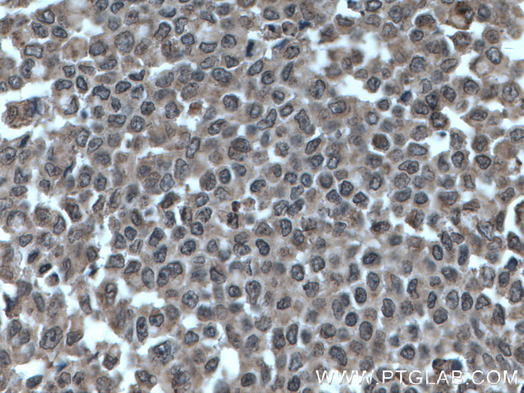 IHC staining of human colon cancer using 27020-1-AP