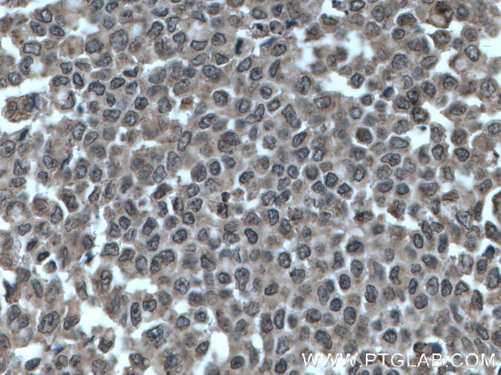 Immunohistochemical analysis of paraffin-embedded human colon cancer tissue slide using 27020-1-AP (SHQ1 antibody) at dilution of 1:200 (under 40x lens. Heat mediated antigen retrieval with Tris-EDTA buffer (pH 9.0). IHC staining of human colon cancer using 27020-1-AP