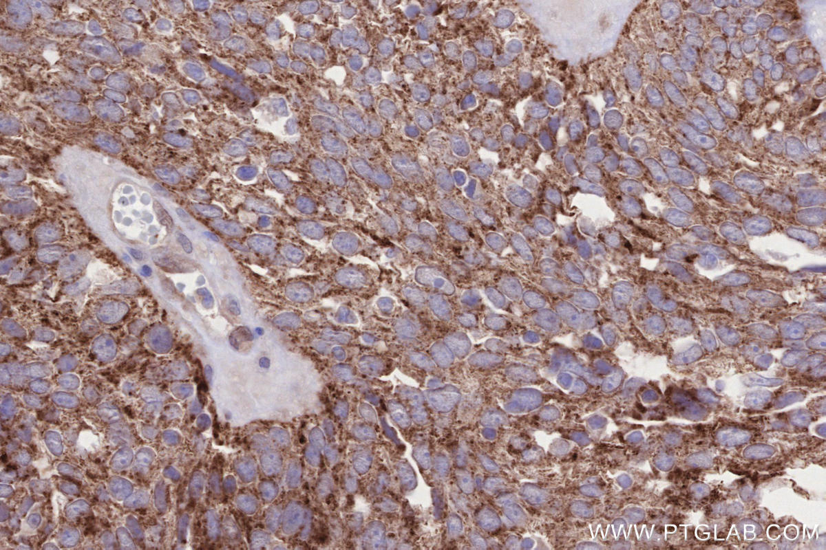 IHC staining of human ovary cancer using 83389-4-RR