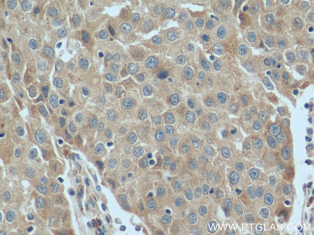 IHC staining of human breast cancer using 55352-1-AP