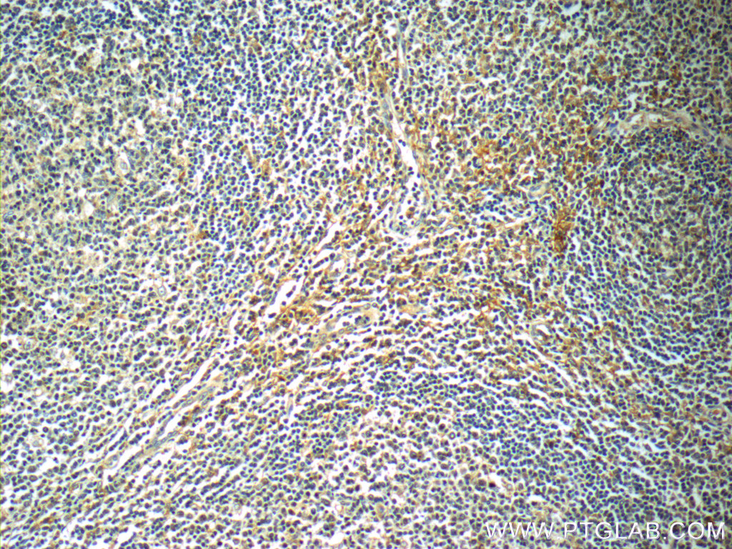 IHC staining of human tonsillitis using 13939-1-AP