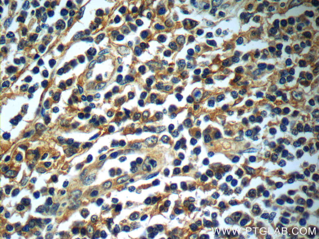 IHC staining of human tonsillitis using 13939-1-AP