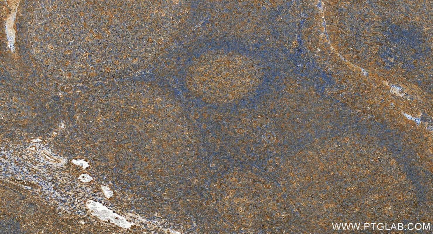 IHC staining of human tonsillitis using 13939-1-AP