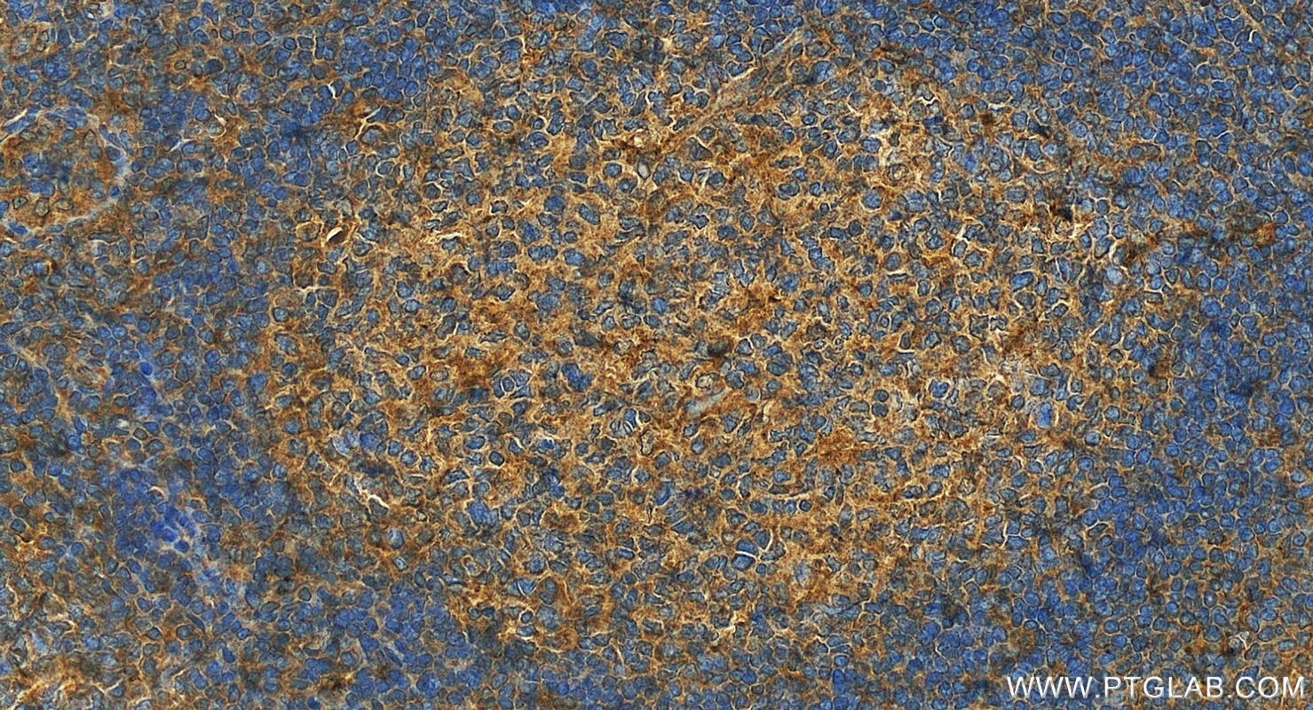 IHC staining of human tonsillitis using 13939-1-AP