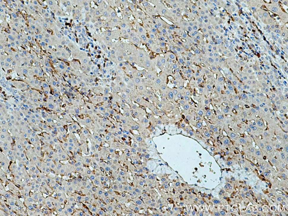 IHC staining of human liver cancer using 13377-1-AP