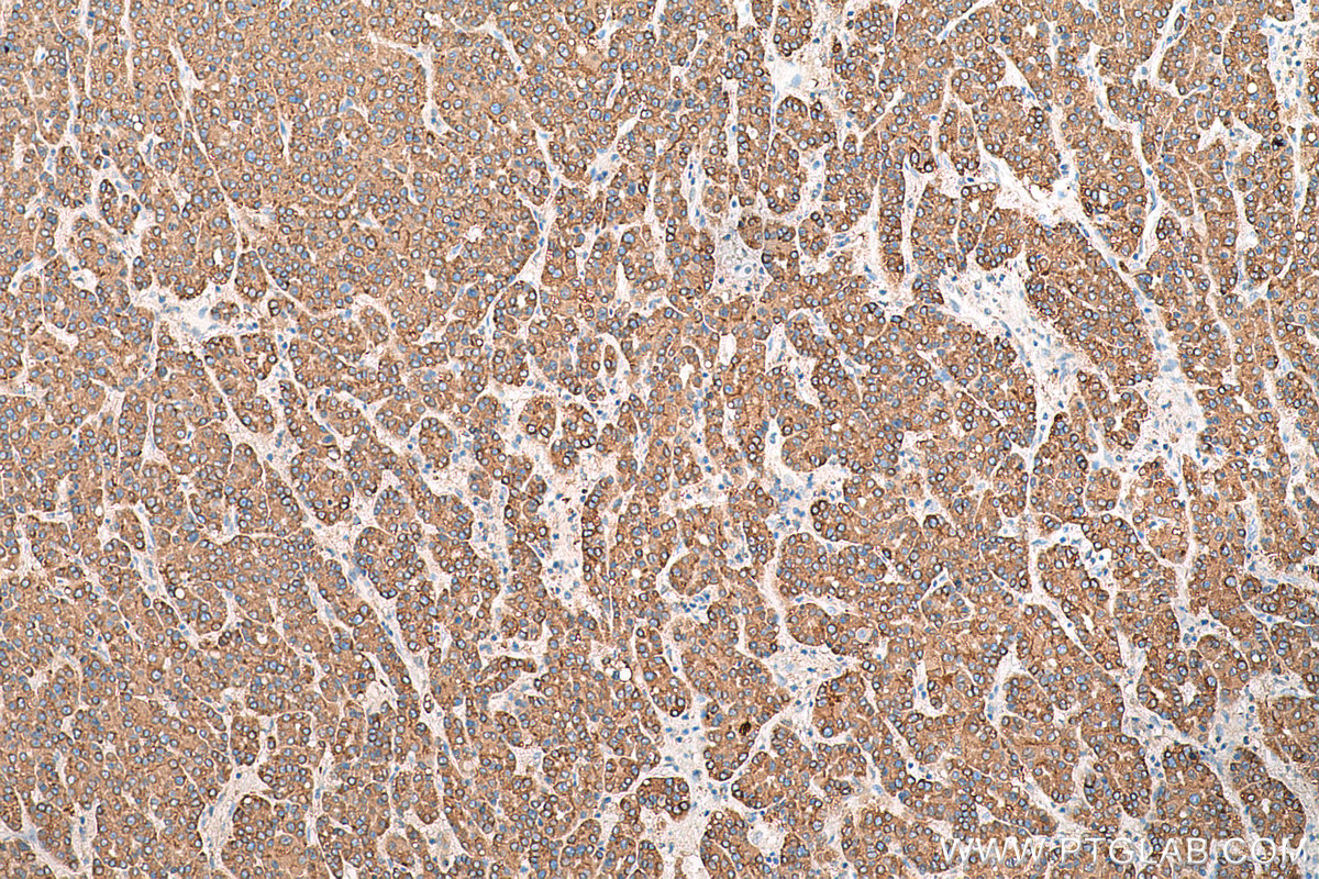 IHC staining of human liver cancer using 15168-1-AP