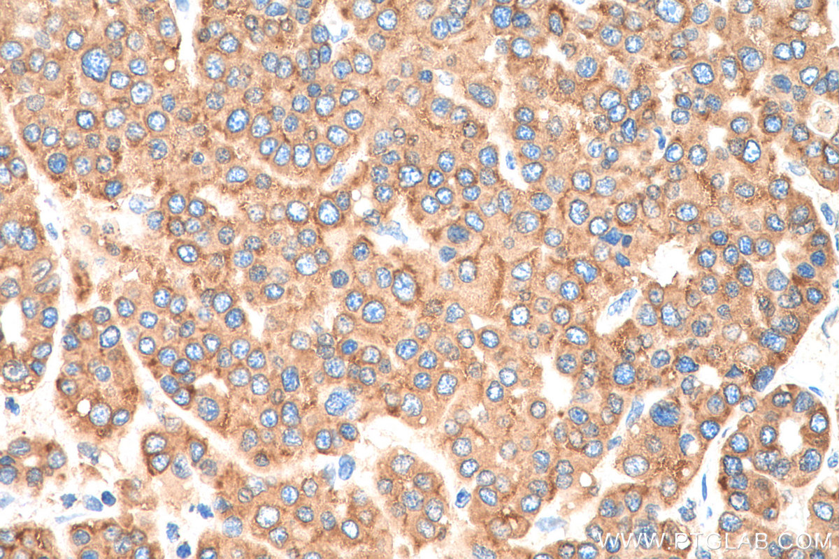 IHC staining of human liver cancer using 15168-1-AP