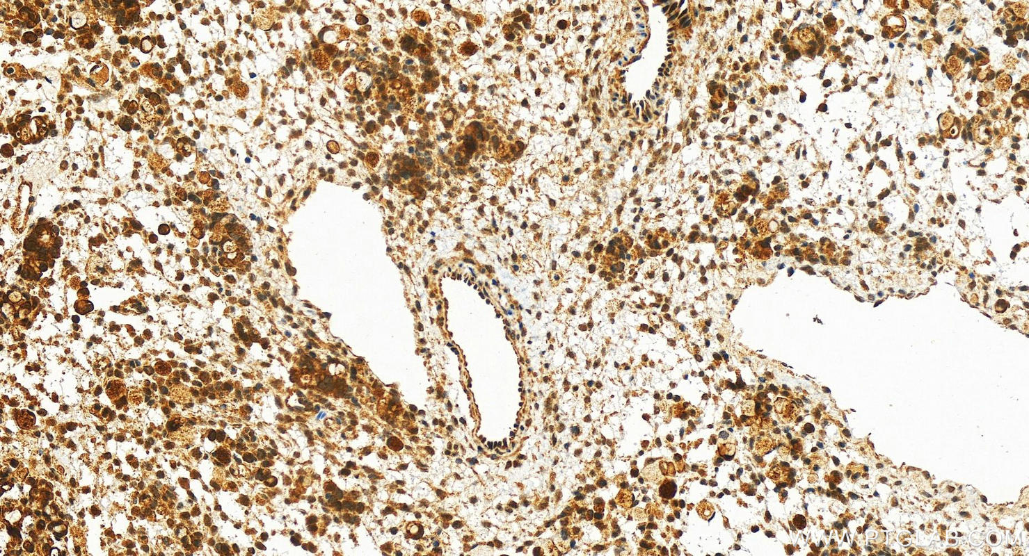IHC staining of human ovary cancer using 27608-1-AP