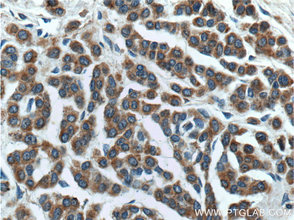 IHC staining of human malignant melanoma using 27329-1-AP