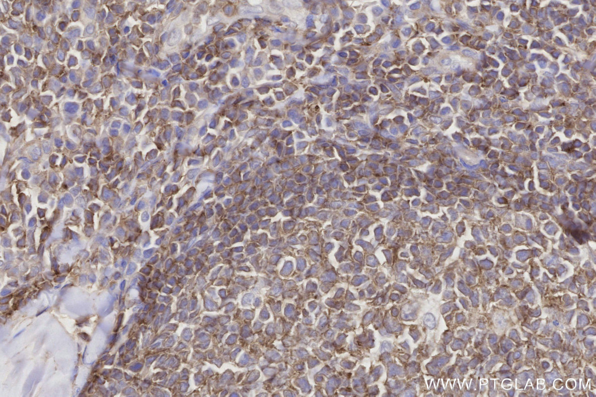 IHC staining of human tonsillitis using 26793-1-AP