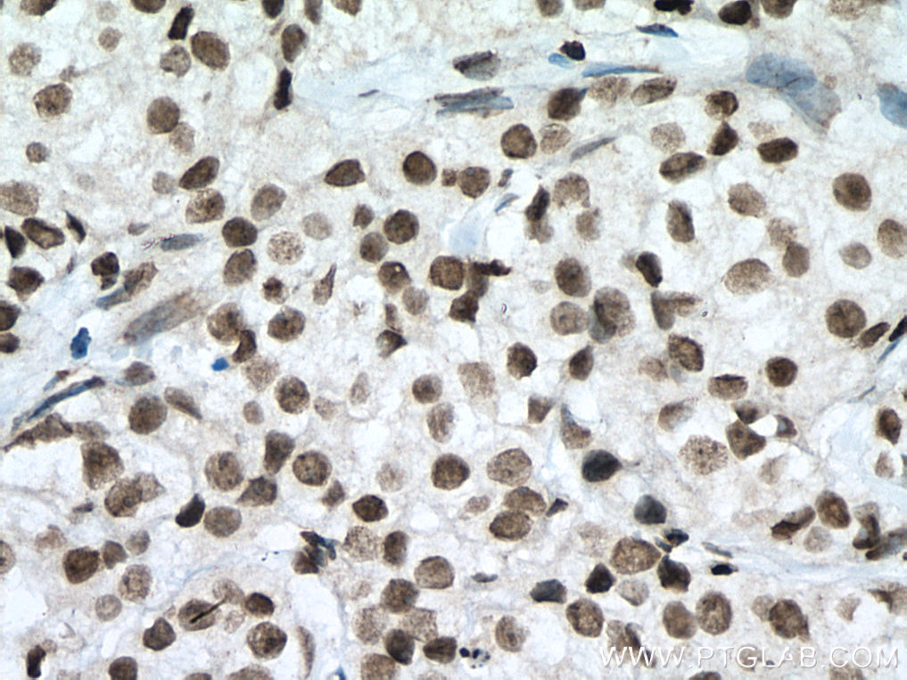 IHC staining of human breast cancer using 60303-1-Ig (same clone as 60303-1-PBS)