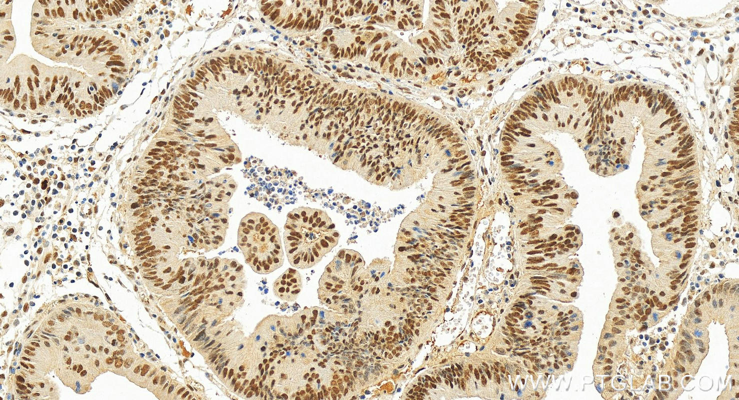 IHC staining of human colon cancer using RMX00009