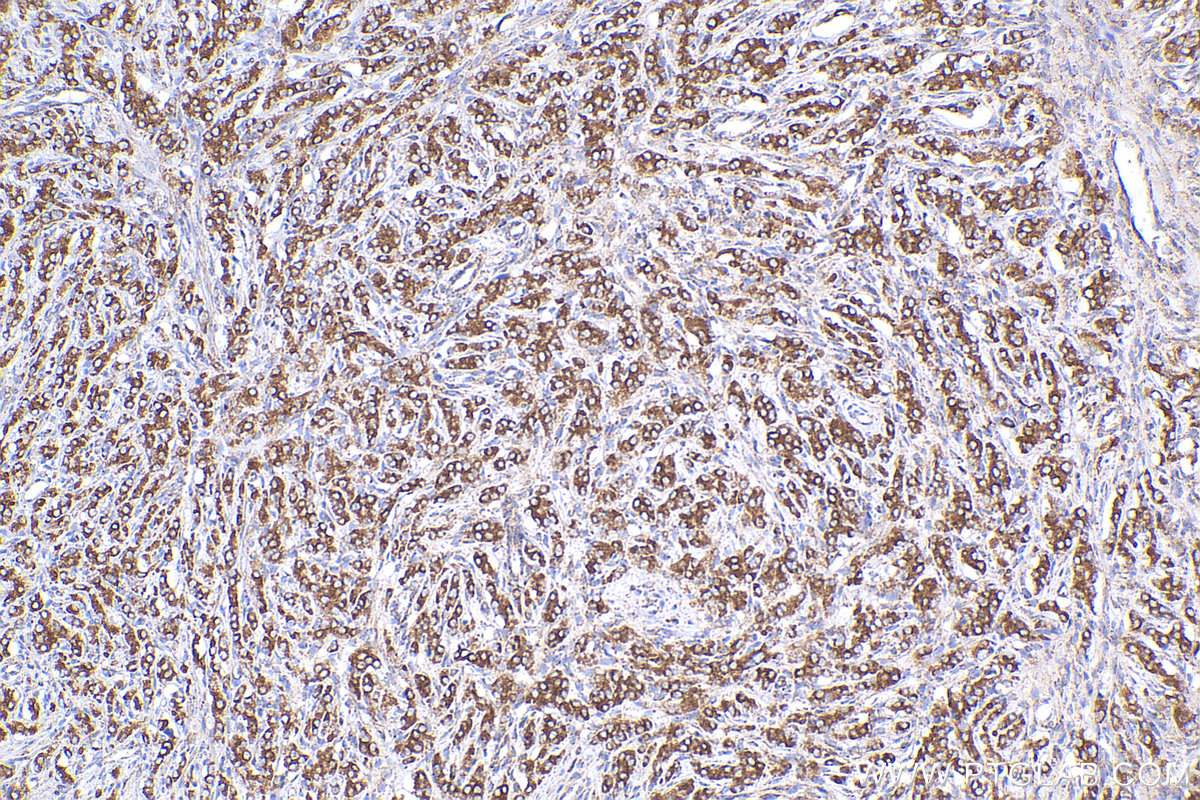 IHC staining of human prostate cancer using 29838-1-AP