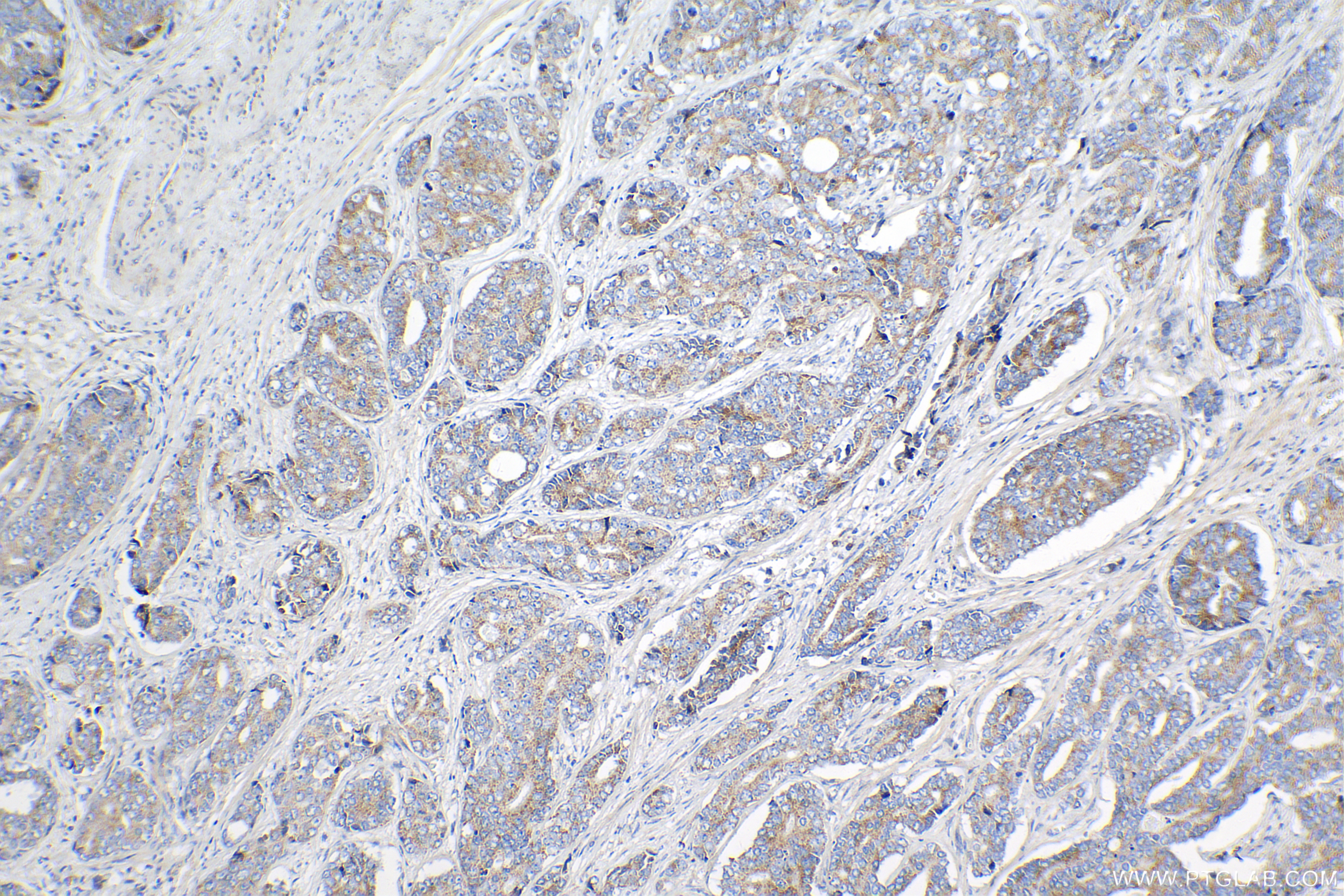 IHC staining of human prostate cancer using 82210-1-RR (same clone as 82210-1-PBS)