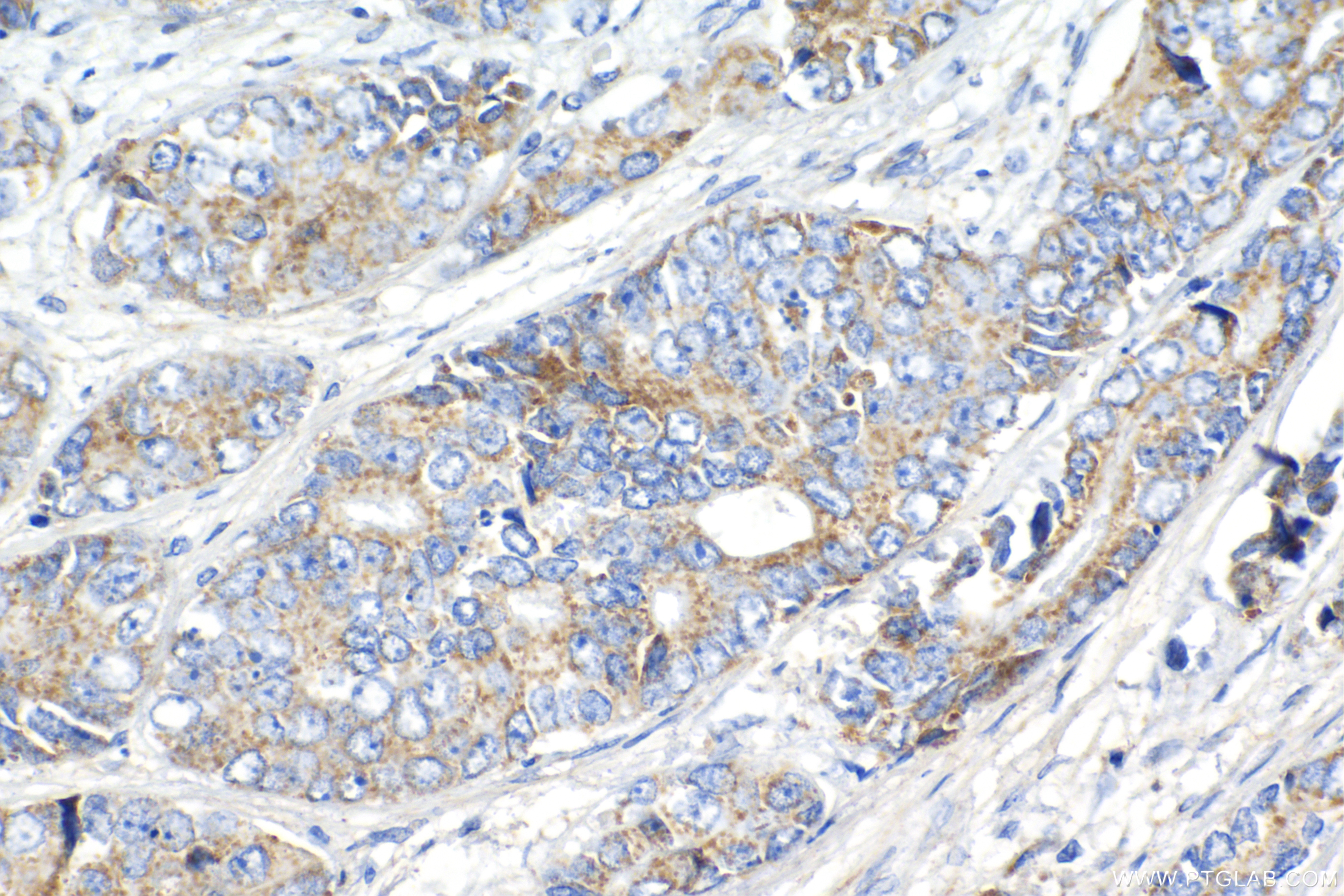 IHC staining of human prostate cancer using 82210-1-RR (same clone as 82210-1-PBS)