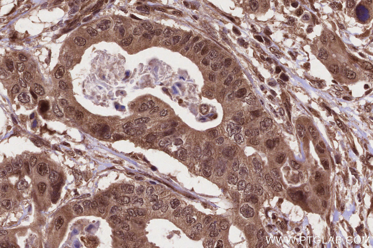 IHC staining of human stomach cancer using 28677-1-AP IHC staining of human stomach cancer using 28677-1-AP