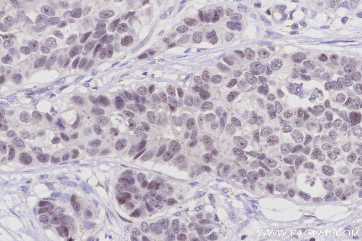 IHC staining of human stomach cancer using 12994-1-AP IHC staining of human stomach cancer using 12994-1-AP