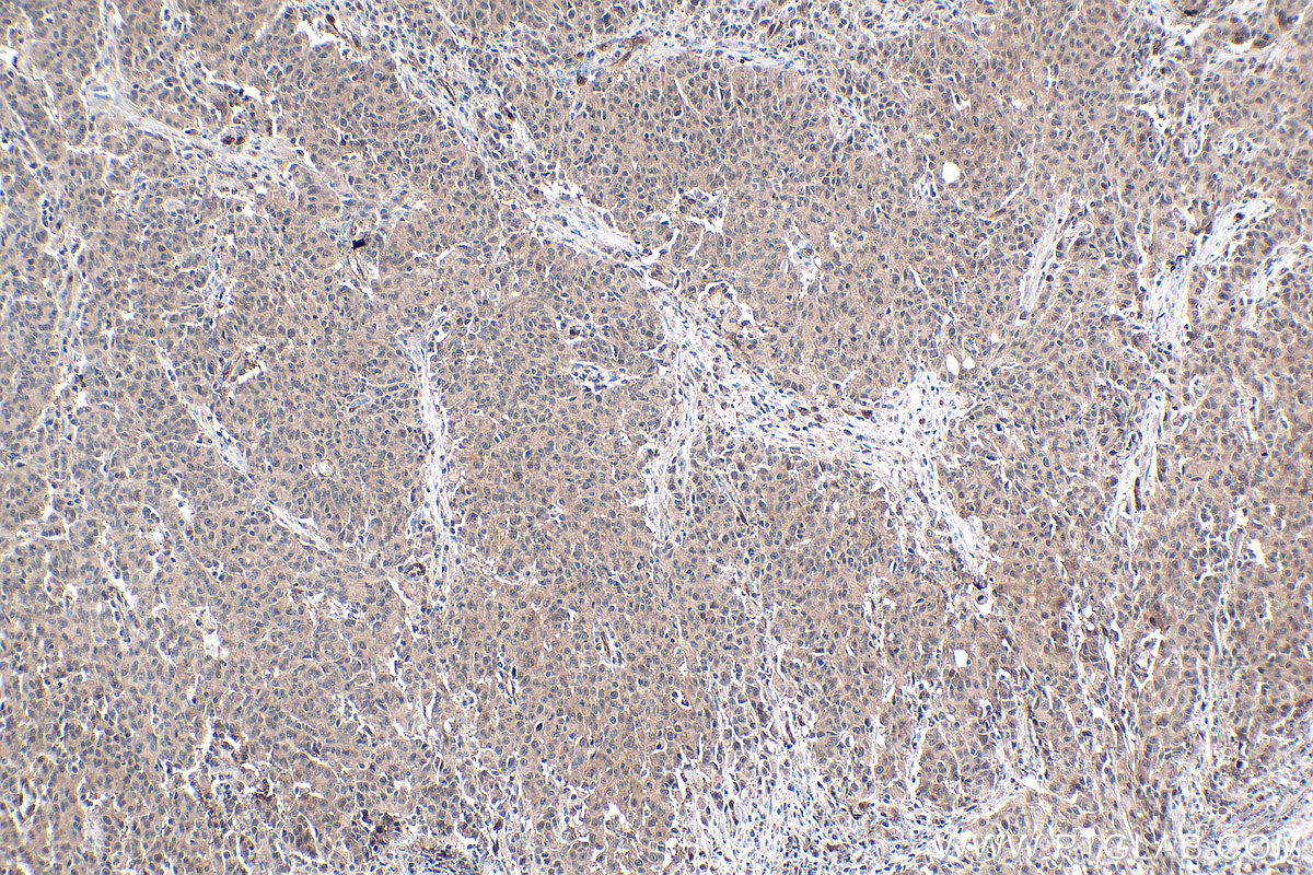 IHC staining of human stomach cancer using 67741-1-Ig (same clone as 67741-1-PBS) IHC staining of human stomach cancer using 67741-1-Ig (same clone as 67741-1-PBS)