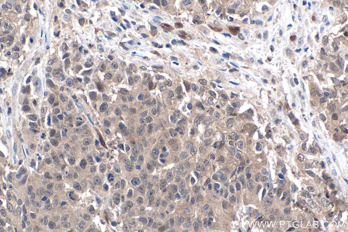 IHC staining of human stomach cancer using 67741-1-Ig (same clone as 67741-1-PBS) IHC staining of human stomach cancer using 67741-1-Ig (same clone as 67741-1-PBS)