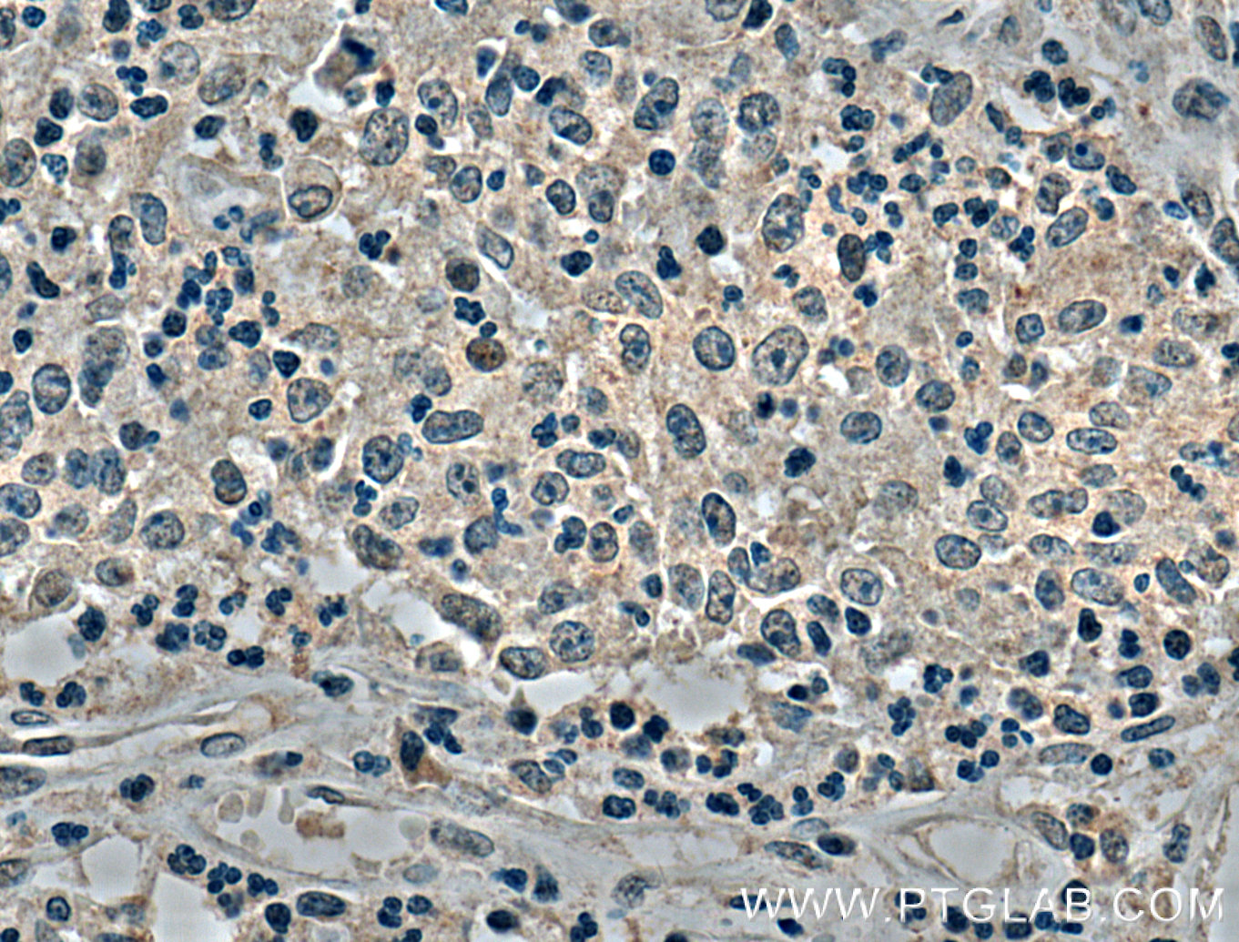 IHC staining of human colon cancer using 66367-1-Ig