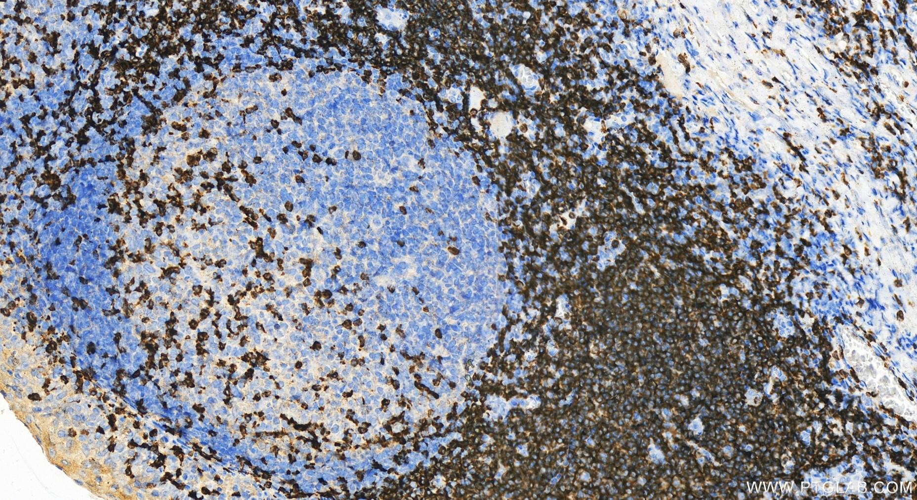 IHC staining of human tonsillitis using 14724-1-AP