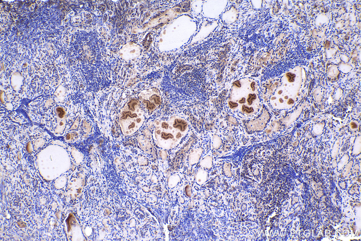 IHC staining of human thyroid cancer using 67745-1-Ig IHC staining of human thyroid cancer using 67745-1-Ig