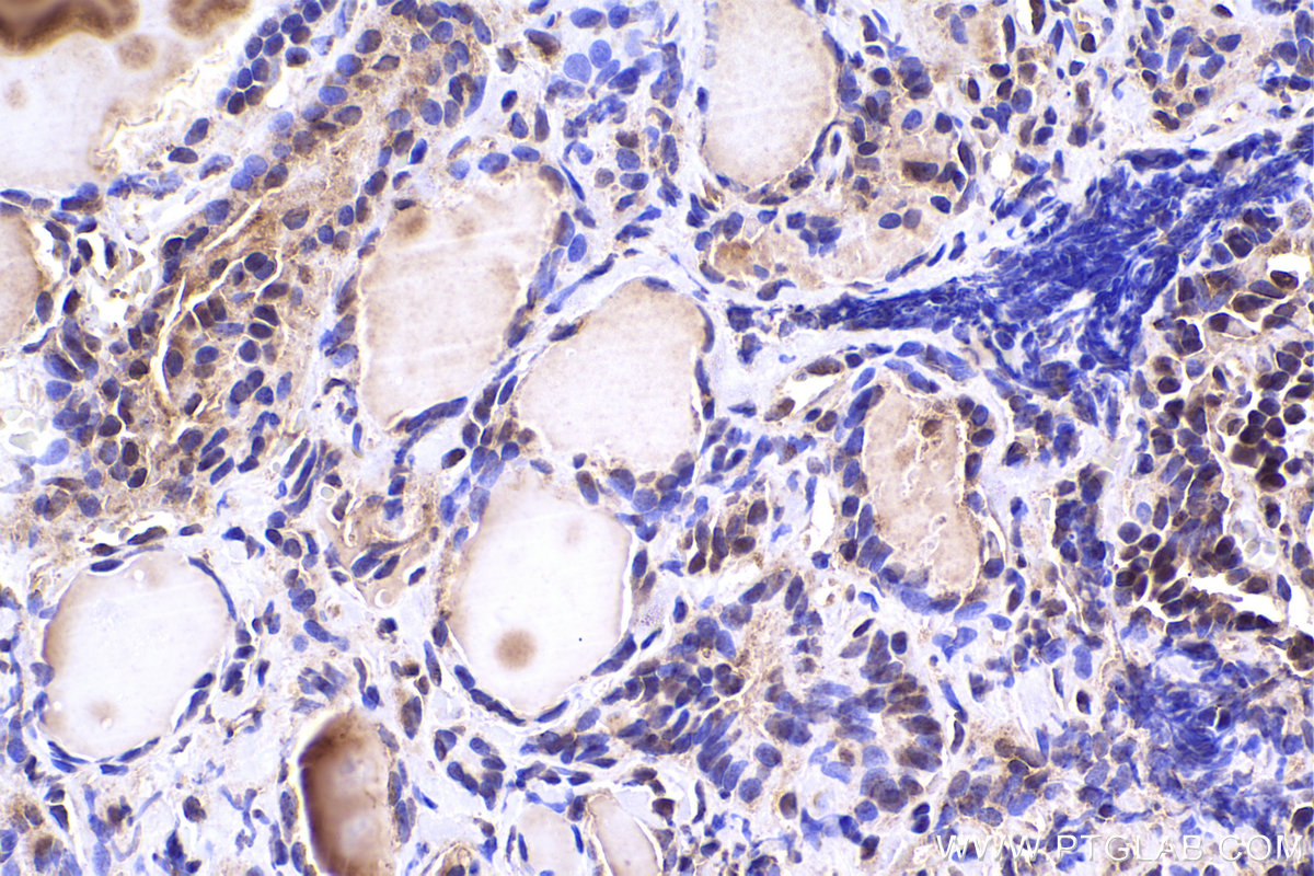 IHC staining of human thyroid cancer using 67745-1-Ig IHC staining of human thyroid cancer using 67745-1-Ig