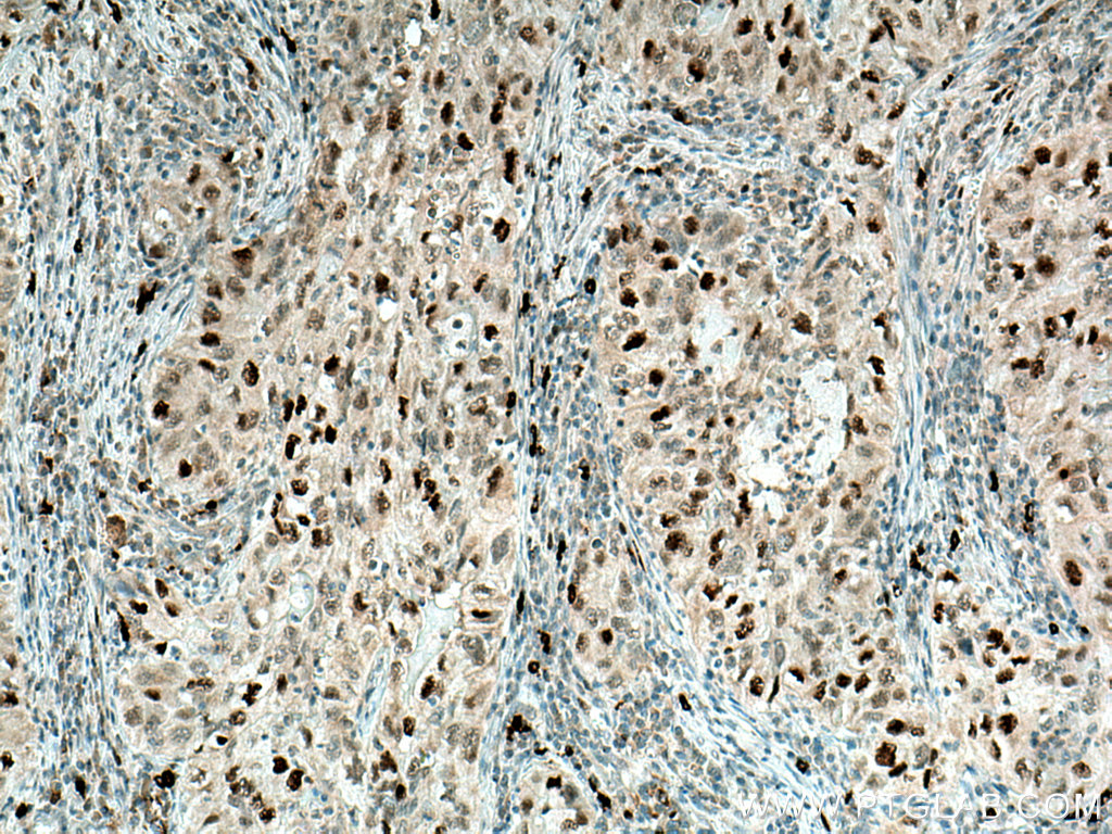 IHC staining of human lung cancer using 15010-1-AP
