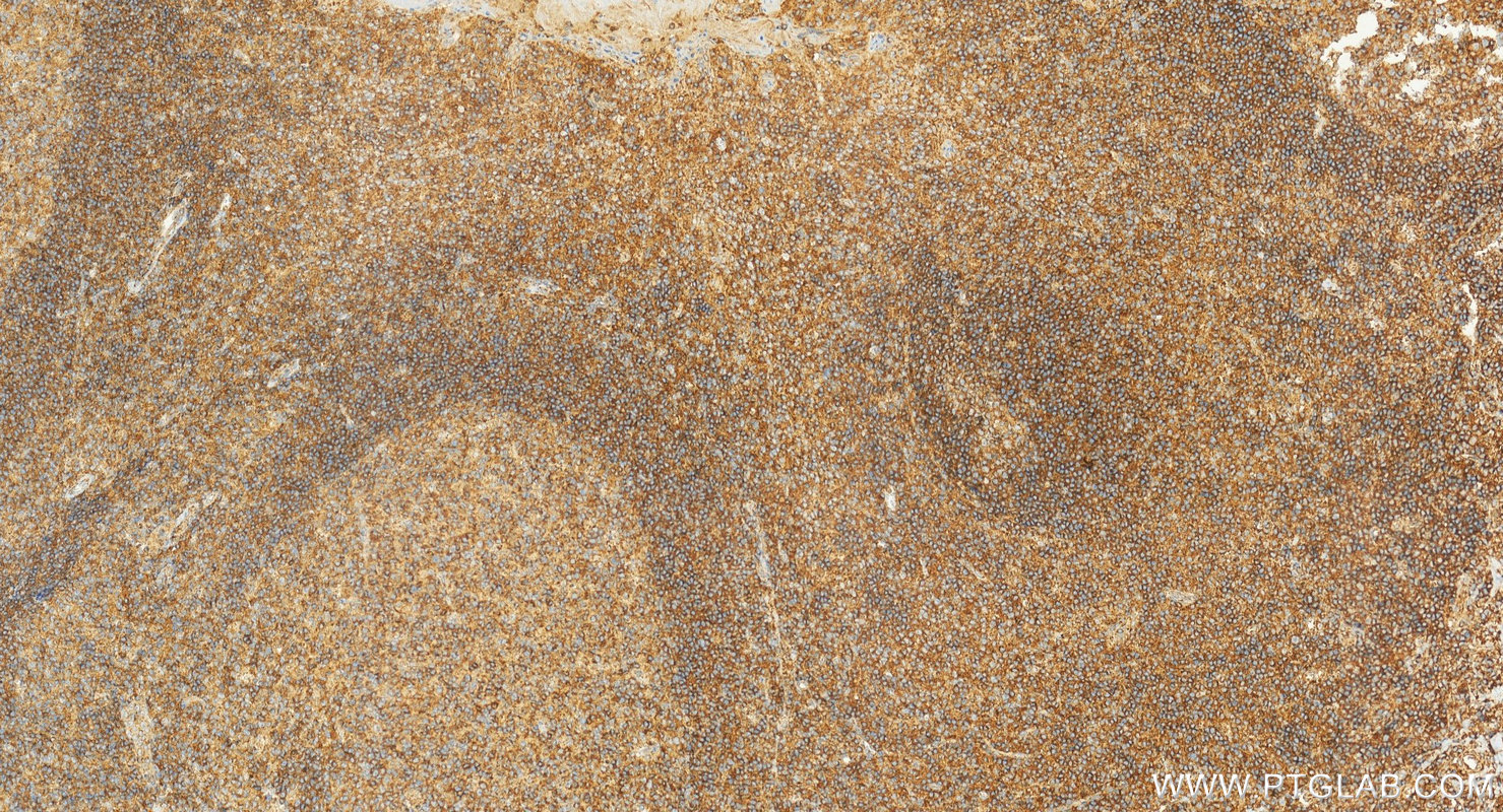 Immunohistochemical analysis of paraffin-embedded human tonsillitis tissue slide using 22711-1-AP (NTB-A/SLAMF6 antibody) at dilution of 1:1000 (under 20x lens). Heat mediated antigen retrieval with Tris-EDTA buffer (pH 9.0). IHC staining of human tonsillitis using 22711-1-AP