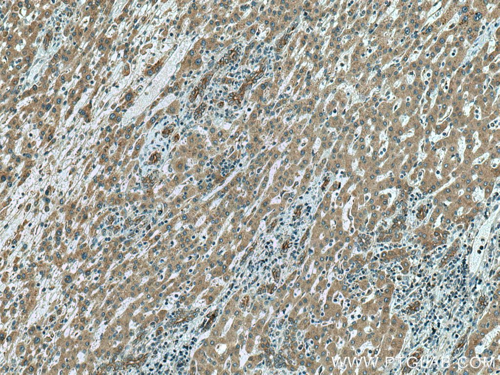 IHC staining of human liver cancer using 15927-1-AP
