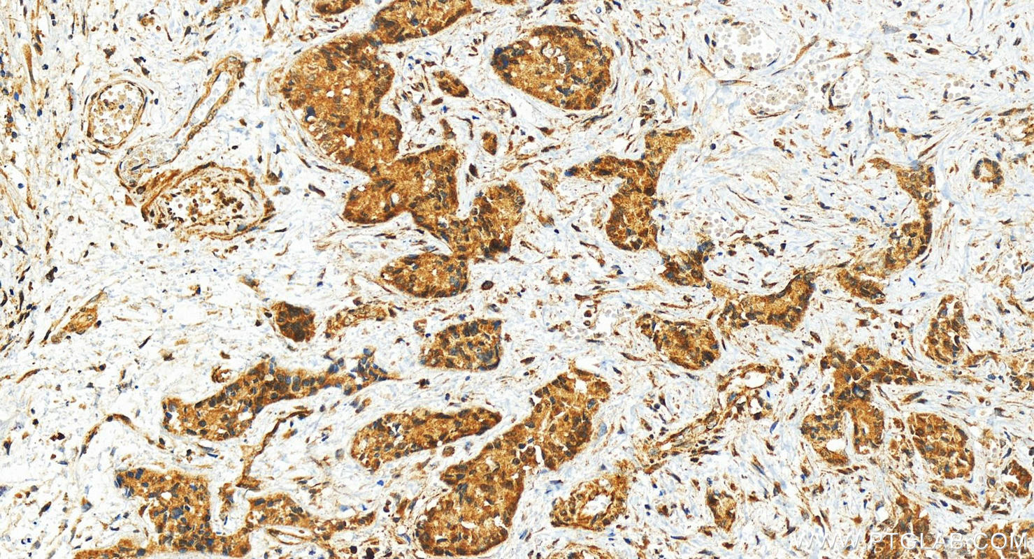 IHC staining of human intrahepatic cholangiocarcinoma using 83225-2-RR (same clone as 83225-2-PBS)