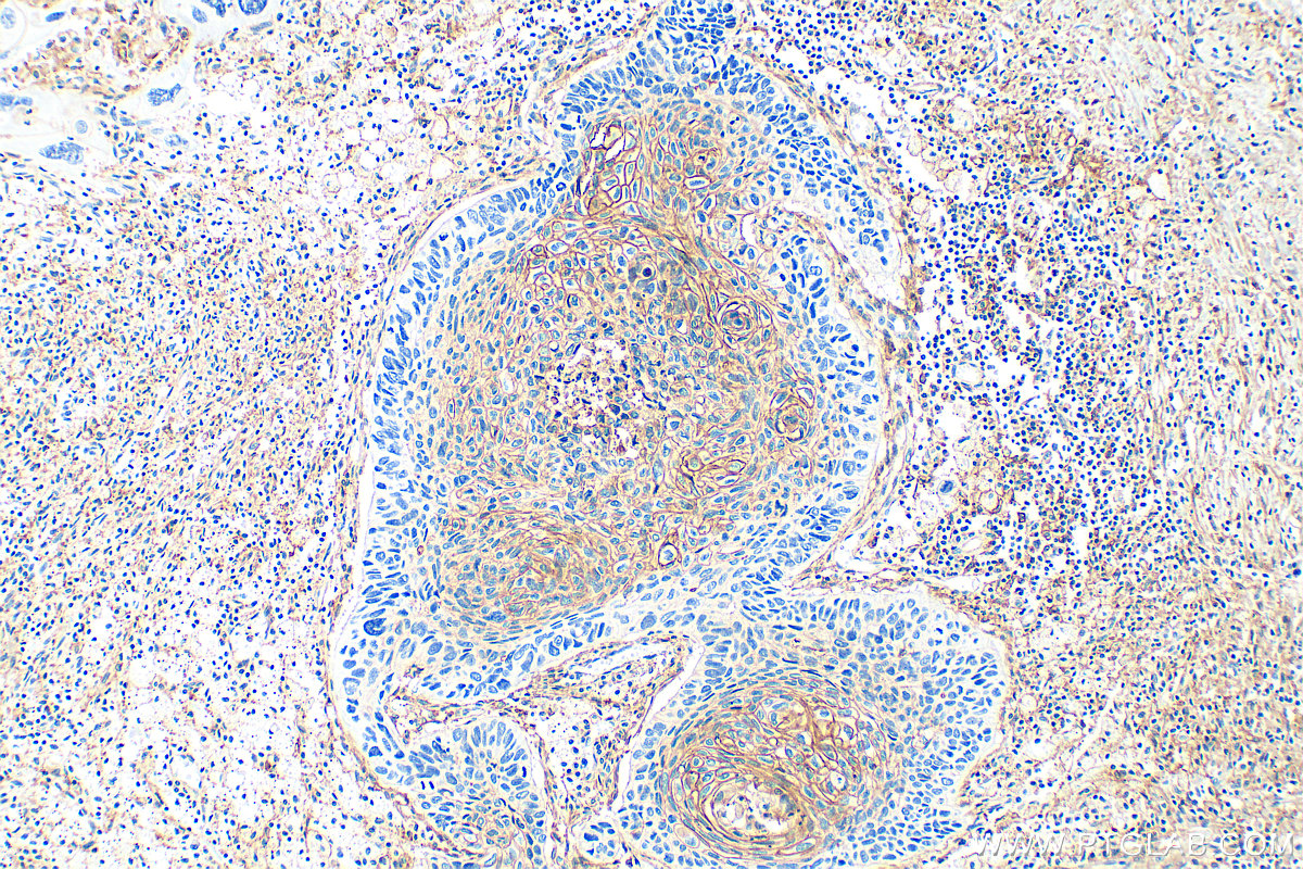 IHC staining of human lung cancer using 22787-1-AP
