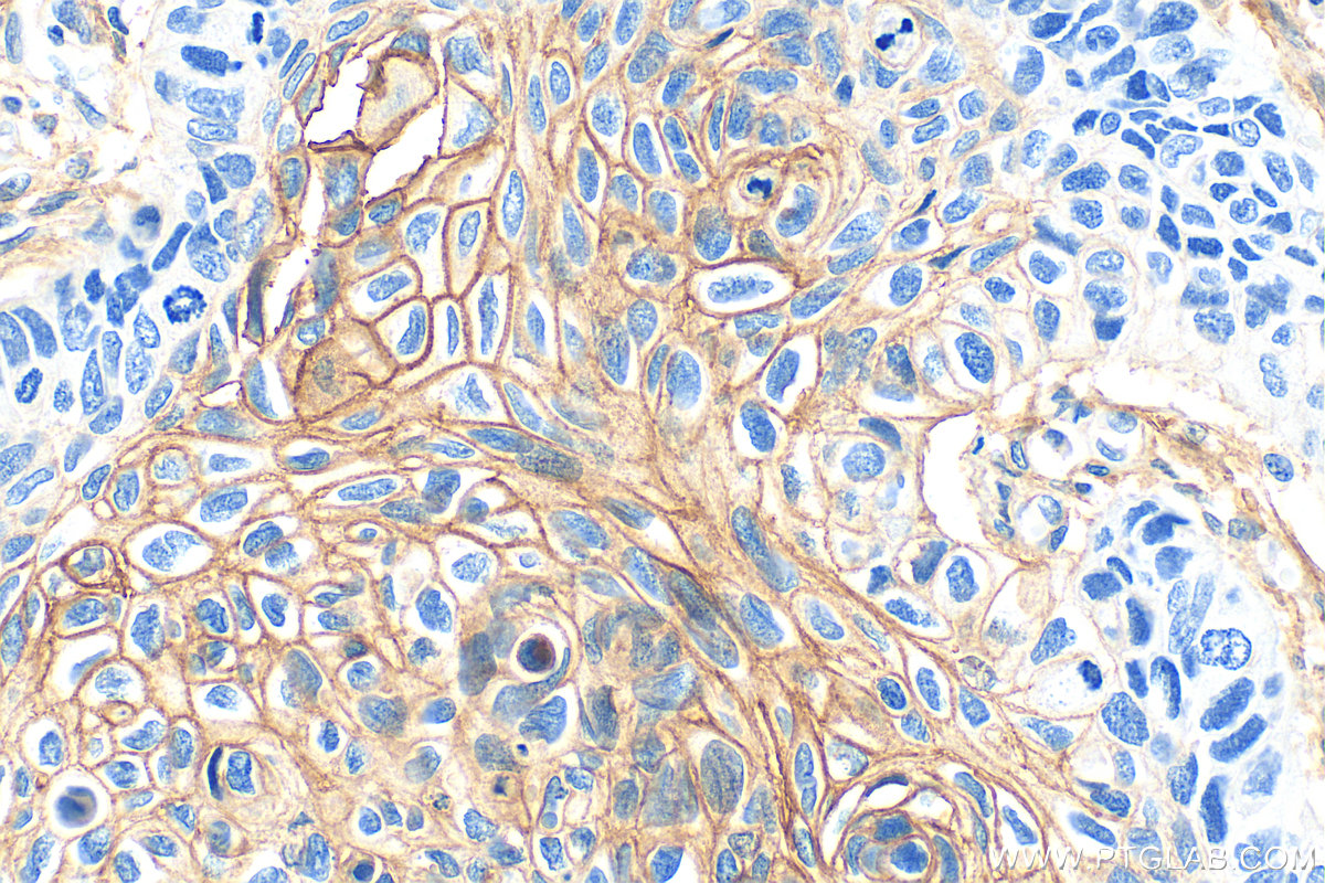 IHC staining of human lung cancer using 22787-1-AP