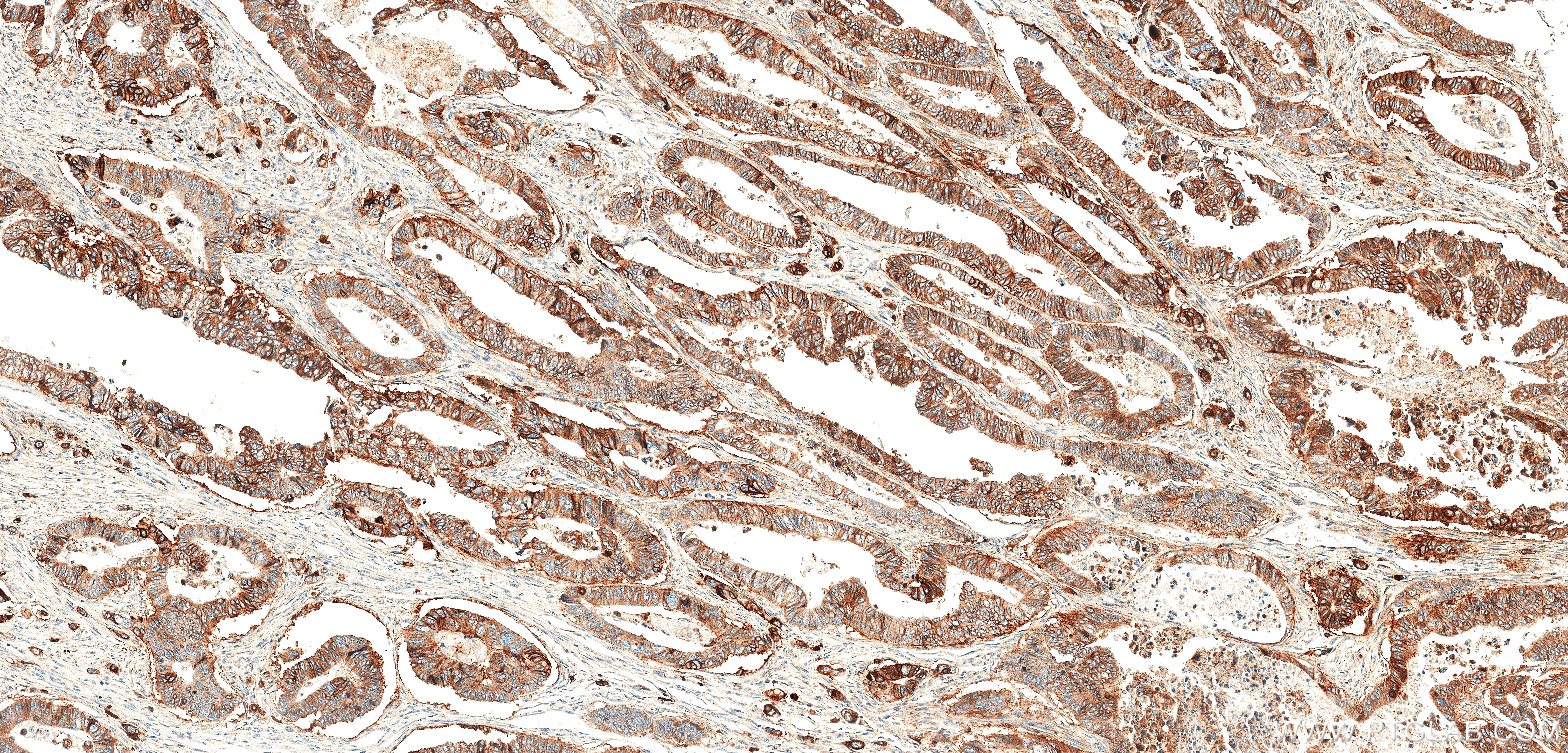 IHC staining of human colon cancer using 87833-2-RR (same clone as 87833-2-PBS)
