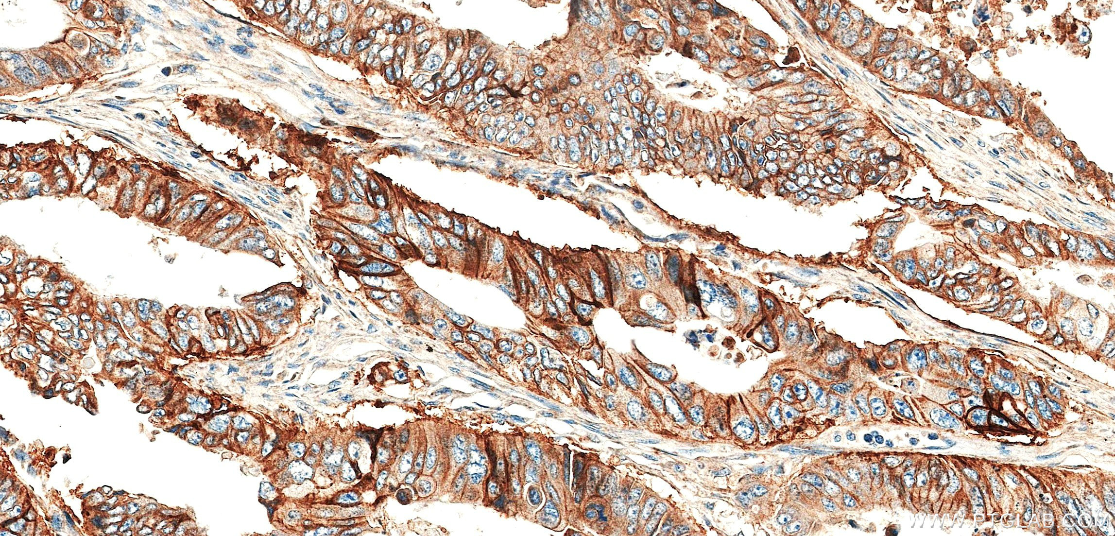 IHC staining of human colon cancer using 87833-2-RR (same clone as 87833-2-PBS)
