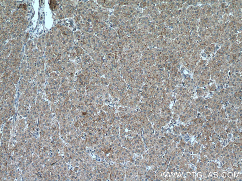 IHC staining of human liver cancer using 27998-1-AP