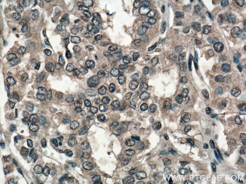 IHC staining of human thyroid cancer using 27747-1-AP