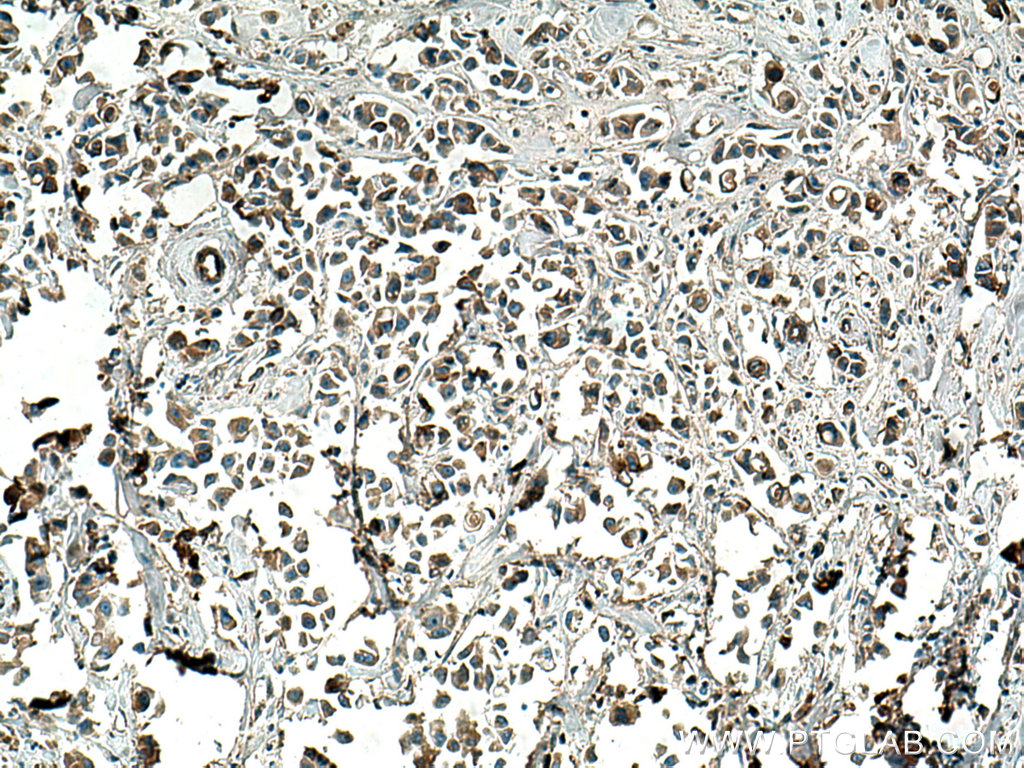 IHC staining of human breast cancer using 15235-1-AP